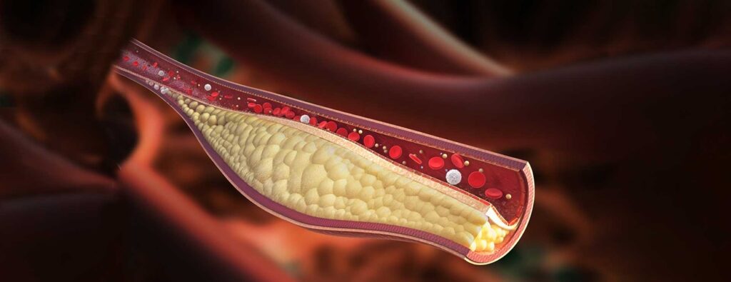 Cholesterol Treatment in Dubai: Comprehensive Guide by Dr. Tamilvendan